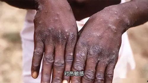 猴子爆料皮肤真假辨别视频,教你轻松辨别皮肤真假